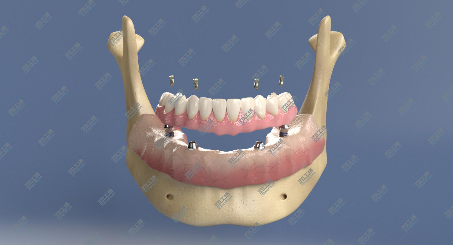 images/goods_img/2021040231/3D Denture with Dental Implants/4.jpg